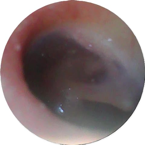 [Australia - AusPower] - WaxRx Wireless Ear Camera, Visual Otoscope for iOS & Android 