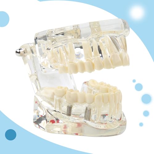 Tooth Model, Transparent Tooth Model with Removable Crown/Bridge, White | Implant dental model, orthodontic dental model, implant demo with removable crown/bridge for training