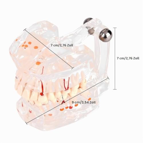Walfront Transparent Dental Implant Teaching Study Standard Teeth Model Demonstration Pathological Educational Dental Teaching Tools