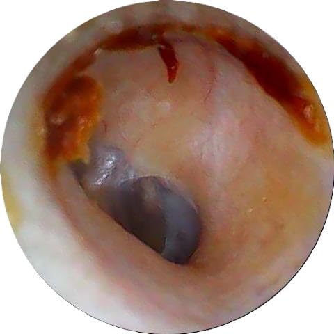[Australia - AusPower] - WaxRx Wireless Ear Camera, Visual Otoscope for iOS & Android 