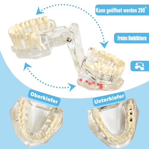 Tooth Model, Transparent Tooth Model with Removable Crown/Bridge, White | Implant dental model, orthodontic dental model, implant demo with removable crown/bridge for training