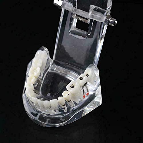 Dental Typodont Implant Restoration Model Dental Pathology Teaching Demonstration Simulation Model (Transparent Clear) Transparent Clear