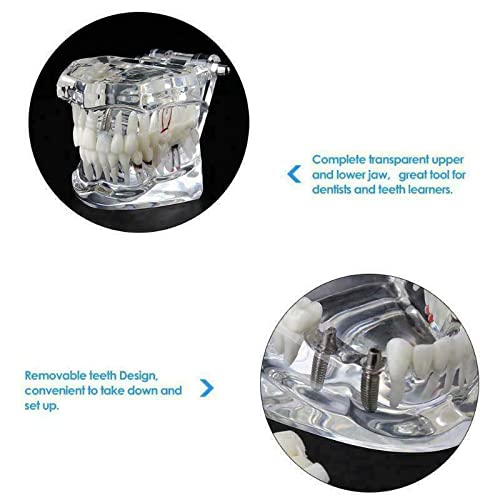 Dental Typodont Implant Restoration Model Dental Pathology Teaching Demonstration Simulation Model (Transparent Clear) Transparent Clear