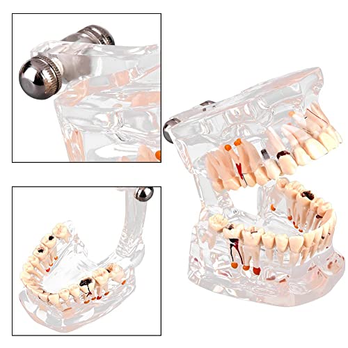 Walfront Transparent Dental Implant Teaching Study Standard Teeth Model Demonstration Pathological Educational Dental Teaching Tools