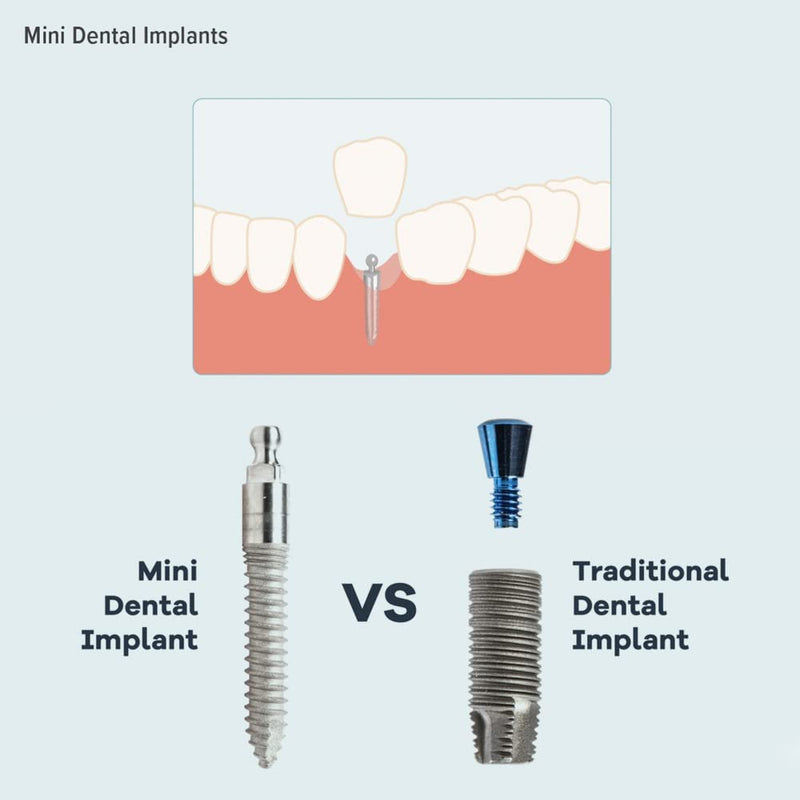[Australia - AusPower] - O-Ring, Buna-n, Tool Kit with 3 Convenient Sizes, Replacement for Mini Dental Implants 