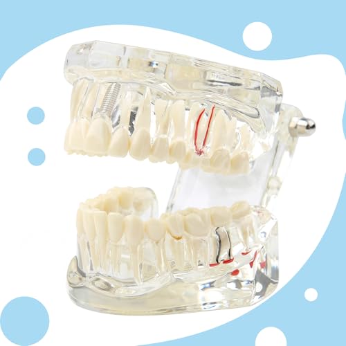 Tooth Model, Transparent Tooth Model with Removable Crown/Bridge, White | Implant dental model, orthodontic dental model, implant demo with removable crown/bridge for training