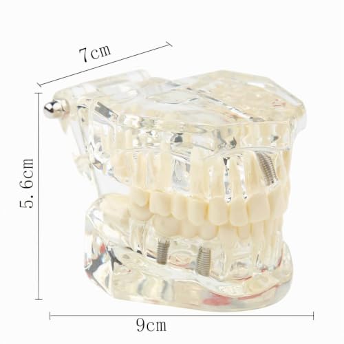 Tooth Model, Transparent Tooth Model with Removable Crown/Bridge, White | Implant dental model, orthodontic dental model, implant demo with removable crown/bridge for training