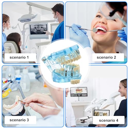 Dental Model with Removable Teeth, Dental Model, Transparent Model for Diseased Teeth, Transparent Tooth Model for Education, Clinic and Patient Demonstration, Blue