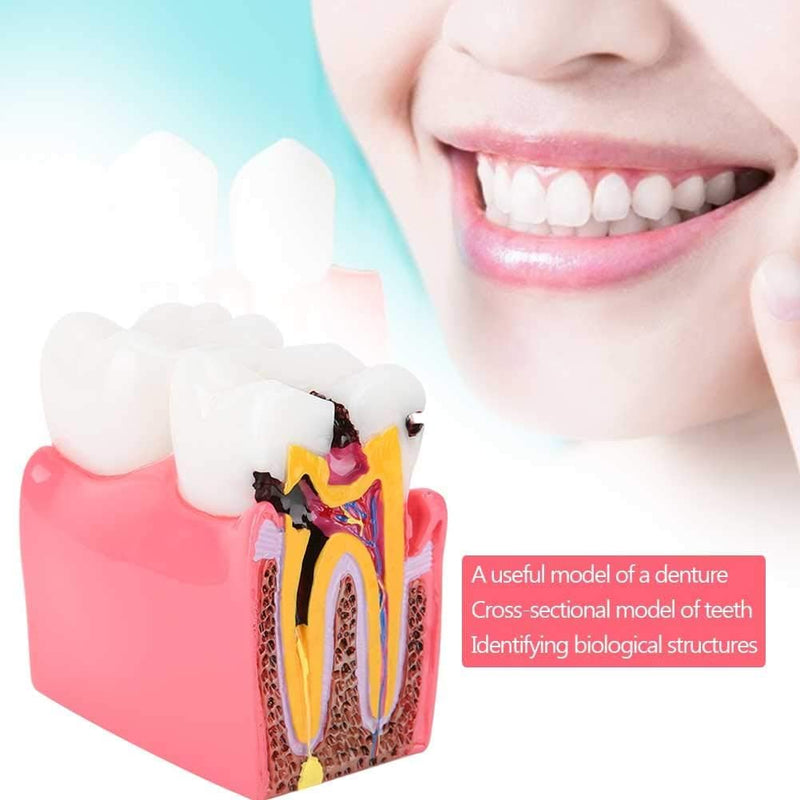 Dental Anatomy Model, Caries Comparison Study Models Dentist Dental Anatomy Training Dental Caries Development Model