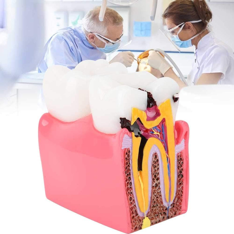 Dental Anatomy Model, Caries Comparison Study Models Dentist Dental Anatomy Training Dental Caries Development Model