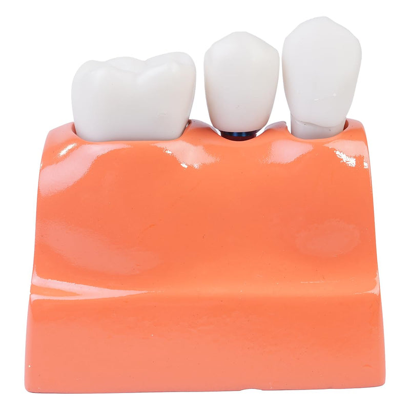 Sarini Oral Dental Model, Dental Implant Model with Removable Crown and Bridge, Suitable for Classroom Demonstrations and Dental Student Training