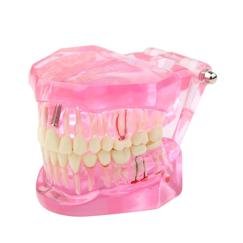 [Australia - AusPower] - Dental Transparent Disease Teeth Model lmplant Teeth Model Analysis Demonstration Standard Teeth Typodont Training Tooth Model with Removable Crown Bridge for Student Education (Pink） pink 