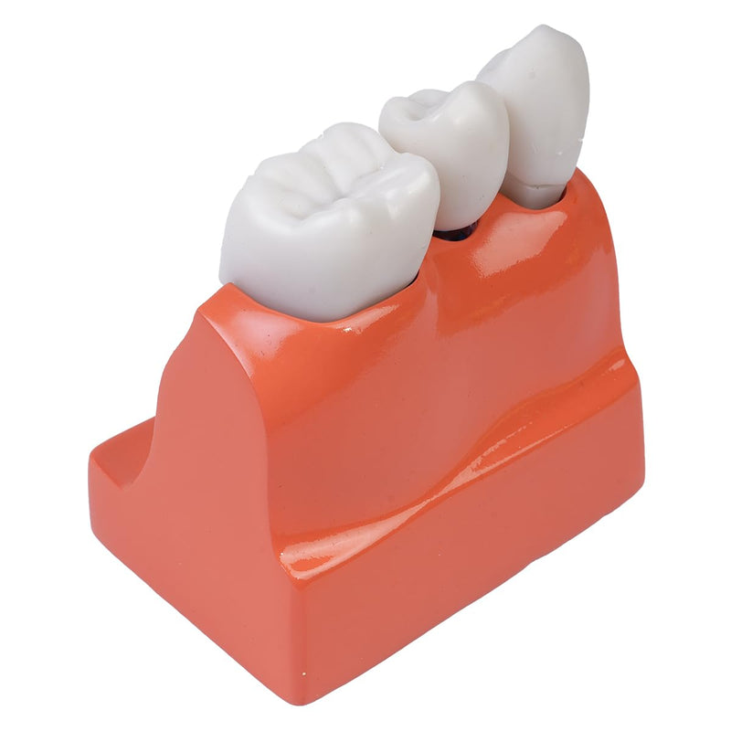 Sarini Oral Dental Model, Dental Implant Model with Removable Crown and Bridge, Suitable for Classroom Demonstrations and Dental Student Training