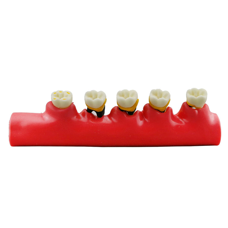 [Australia - AusPower] - Teeth Periodontal Disease Model Dental Caries Breakdown Display Periodontitis Show Teaching Tooth Model Dentist Odontologia Communication 