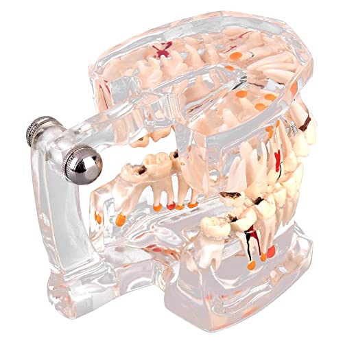 Walfront Transparent Dental Implant Teaching Study Standard Teeth Model Demonstration Pathological Educational Dental Teaching Tools