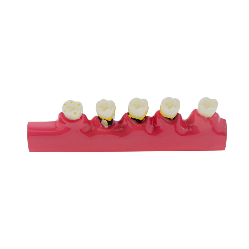 [Australia - AusPower] - Dental Teeth Model 6-Stage Periodontal Disease Demonstration Model for Dental Education 