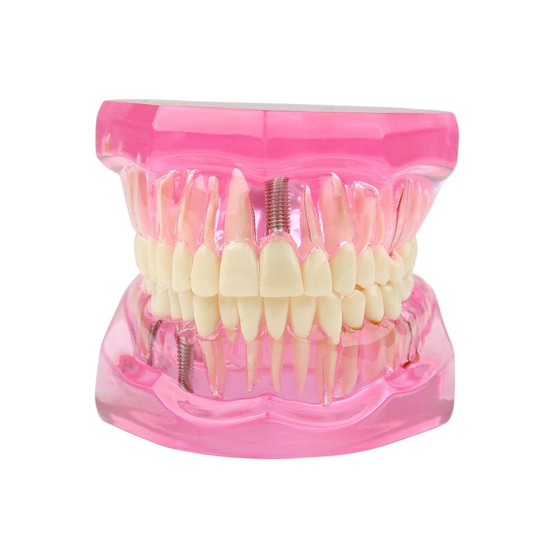 [Australia - AusPower] - Dental Transparent Disease Teeth Model lmplant Teeth Model Analysis Demonstration Standard Teeth Typodont Training Tooth Model with Removable Crown Bridge for Student Education (Pink） pink 