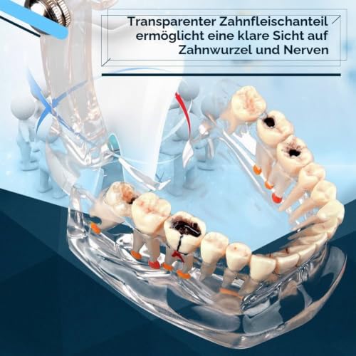 Walfront Transparent Dental Implant Teaching Study Standard Teeth Model Demonstration Pathological Educational Dental Teaching Tools