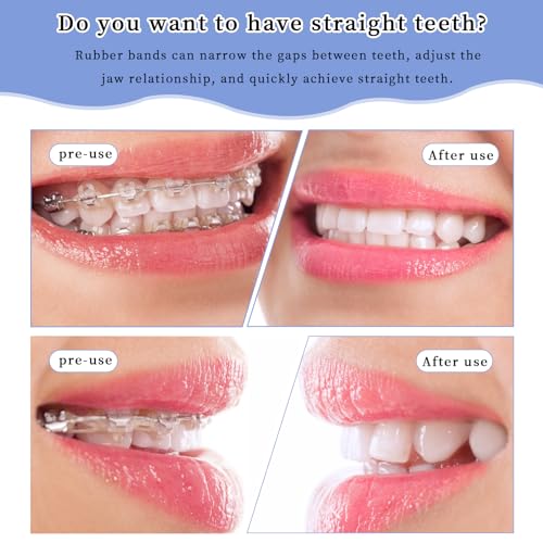 Pack of 500 Orthodontic Elastic Braces Rubber, Orthodontic Latex Elastics, with 5 Pieces Placements, Suitable for Braces, Gaps and Crooked Teeth (Fox 1/4 Inch)