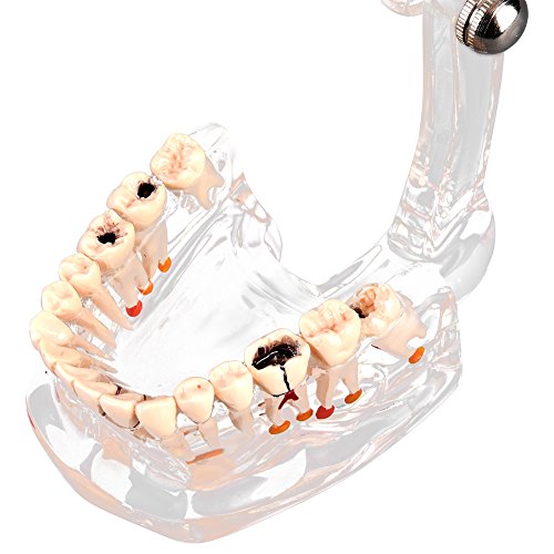 Walfront Transparent Dental Implant Teaching Study Standard Teeth Model Demonstration Pathological Educational Dental Teaching Tools