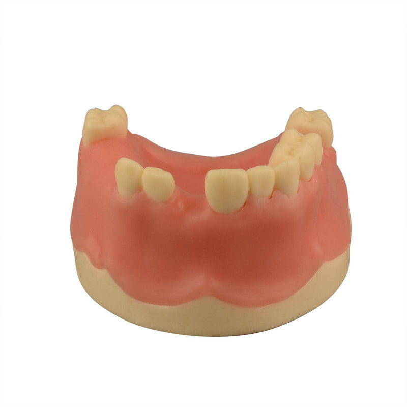 [Australia - AusPower] - Maxillary Dental Implant Model Missing Partial Teeth, Basic Implant Training Model with Practice Soft Gums, Great Dental Training Tooth for Dental Implant Practice 