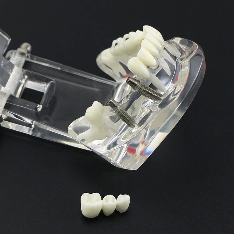 Dental Typodont Implant Restoration Model Dental Pathology Teaching Demonstration Simulation Model (Transparent Clear) Transparent Clear