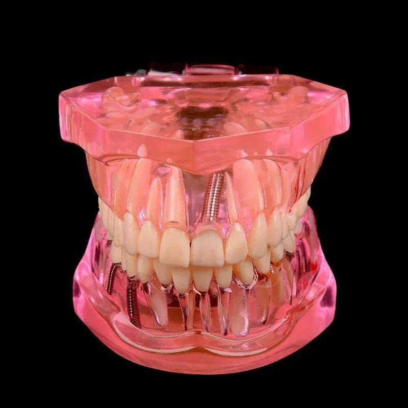[Australia - AusPower] - Dental Transparent Disease Teeth Model lmplant Teeth Model Analysis Demonstration Standard Teeth Typodont Training Tooth Model with Removable Crown Bridge for Student Education (Pink） pink 