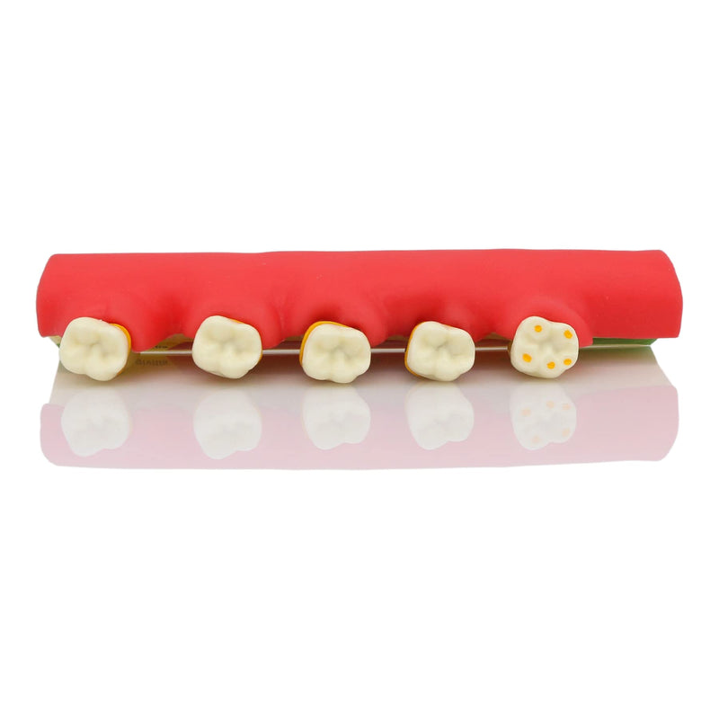 [Australia - AusPower] - Teeth Periodontal Disease Model Dental Caries Breakdown Display Periodontitis Show Teaching Tooth Model Dentist Odontologia Communication 