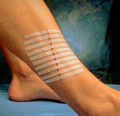 [Australia - AusPower] - 3M Steri-Strip™ Skin Closures, Reinforced, 1/4" x 1 1/2", 6/Pk, 50Pks/Bx 