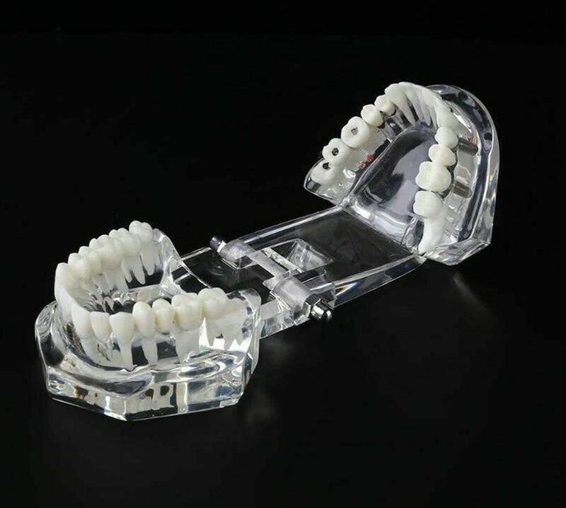 Dental Typodont Implant Restoration Model Dental Pathology Teaching Demonstration Simulation Model (Transparent Clear) Transparent Clear