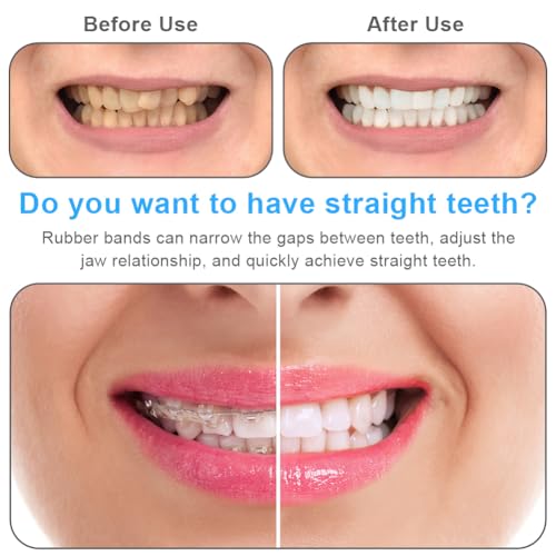 OFFCUP Orthodontic Elastic Teeth, Pack of 500 | Orthodontic Elastics with 5 Braces Placer for Gap Braces, Braces, Crooked (Rabbit 3/16") 3/16''