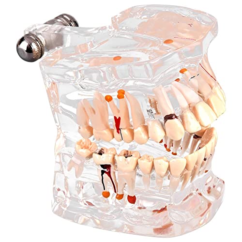 Walfront Transparent Dental Implant Teaching Study Standard Teeth Model Demonstration Pathological Educational Dental Teaching Tools
