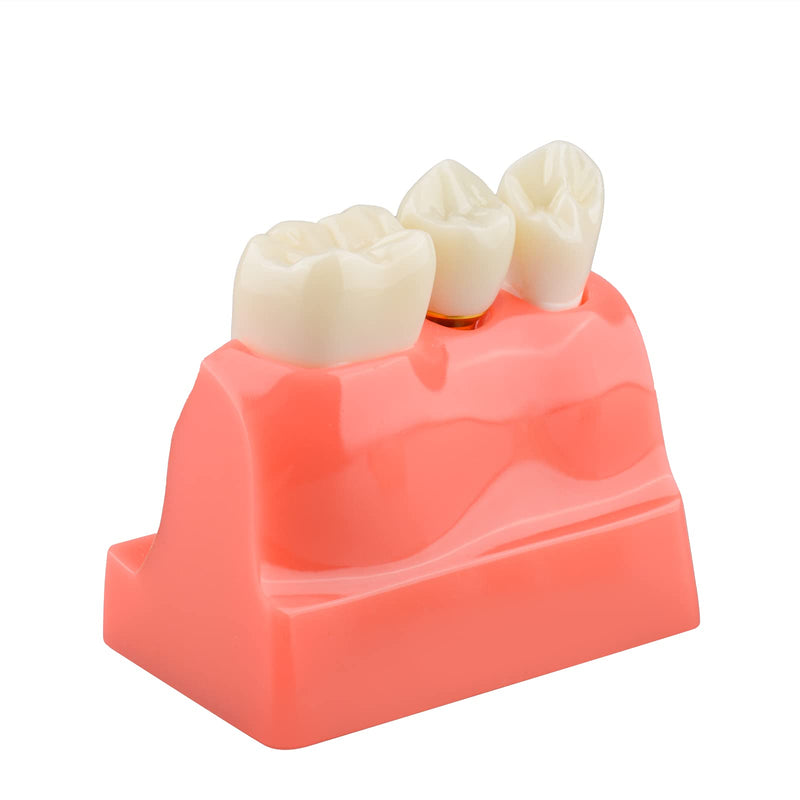 [Australia - AusPower] - Dental Implant Model for Patient Education, 4 Times Dental Implant, Crown and Bridge Model for Presentation-Pink 