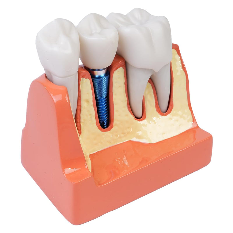 Sarini Oral Dental Model, Dental Implant Model with Removable Crown and Bridge, Suitable for Classroom Demonstrations and Dental Student Training