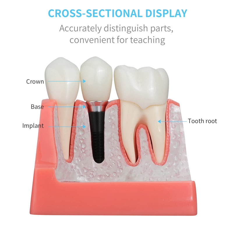 [Australia - AusPower] - ANNWAN Dental Implant Model 4 Times Removable Analysis Crown Bridge Demonstration Teeth Model for Class Education and Studying Teeth Model 