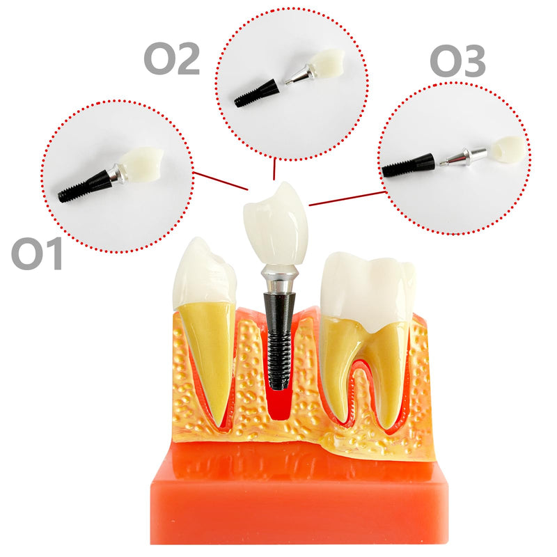 [Australia - AusPower] - Dental Implant Model with Removable Crown Bridge - 4 Times Enlarged Demonstrative Teeth Model for Education and Study - Ideal for Class Demonstrations and Dental Student Training 