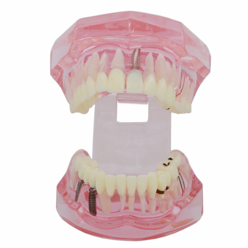 [Australia - AusPower] - Teeth Model Teeth Typodonts Dental Implant Study Analysis Demonstration Teeth Model #2001 with Restoration Pink 
