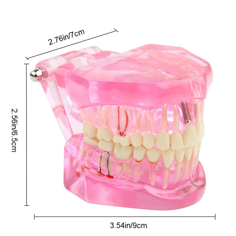 [Australia - AusPower] - Dental Transparent Disease Teeth Model lmplant Teeth Model Analysis Demonstration Standard Teeth Typodont Training Tooth Model with Removable Crown Bridge for Student Education (Pink） pink 
