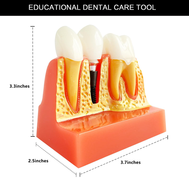 [Australia - AusPower] - Dental Implant Model with Removable Crown Bridge - 4 Times Enlarged Demonstrative Teeth Model for Education and Study - Ideal for Class Demonstrations and Dental Student Training 