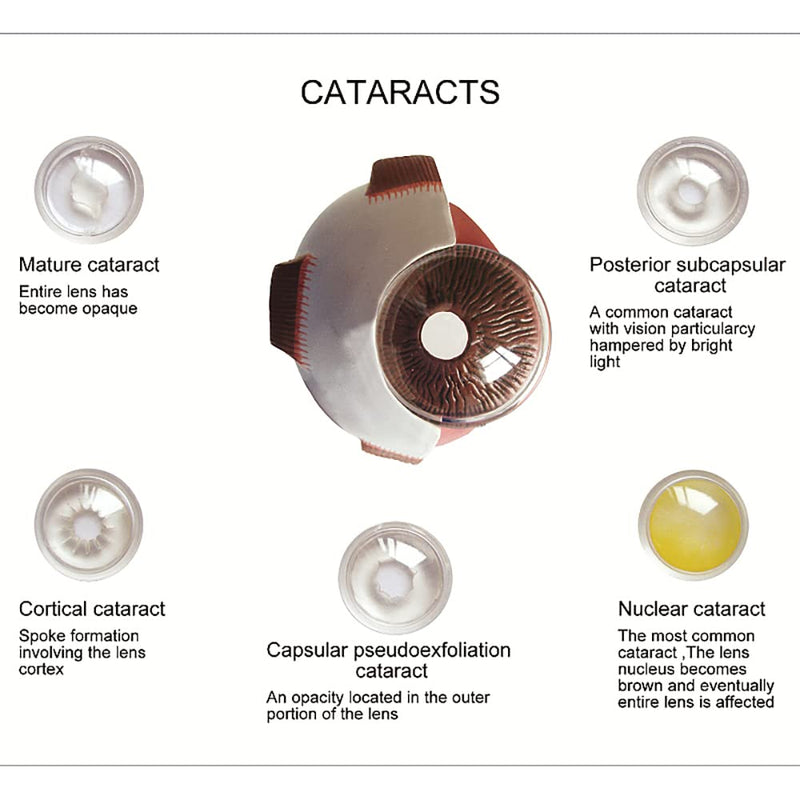 Cornea Eyeball Model Human Eye Model Human Eye Demonstration Teaching Prop Cataract Anatomy Medical Teaching Model