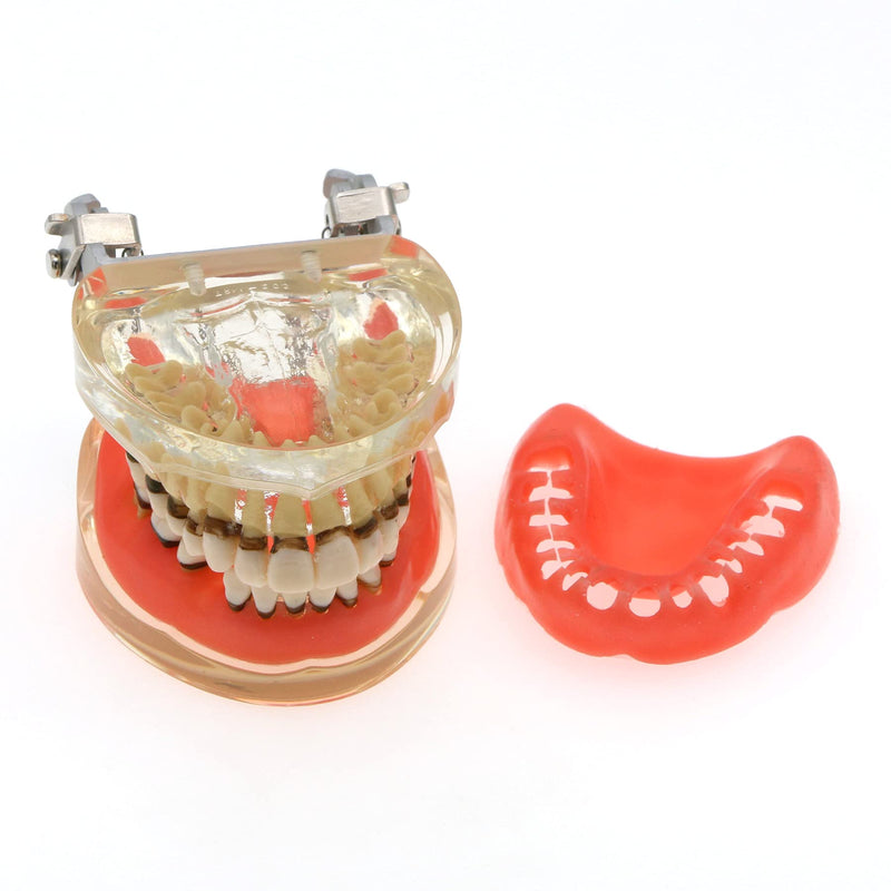 [Australia - AusPower] - Dental Teeth Typodonts Model for Parodontopathy Periodontal Disease, Removable Gingivae Pathology Teeth Model Used in Teaching,Explain,Studying for Adult(Transparent) 