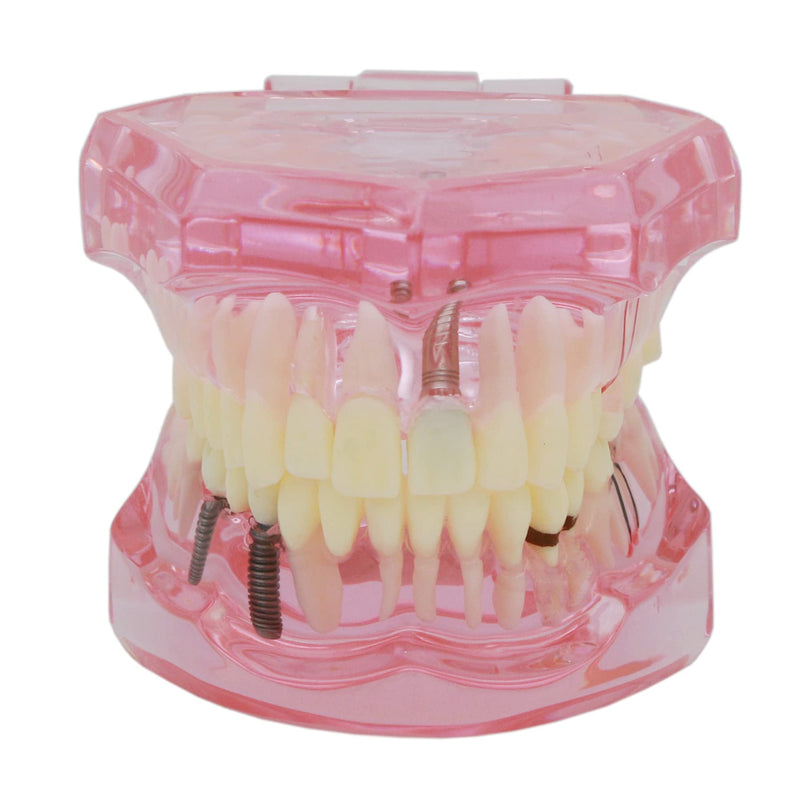[Australia - AusPower] - Teeth Model Teeth Typodonts Dental Implant Study Analysis Demonstration Teeth Model #2001 with Restoration Pink 