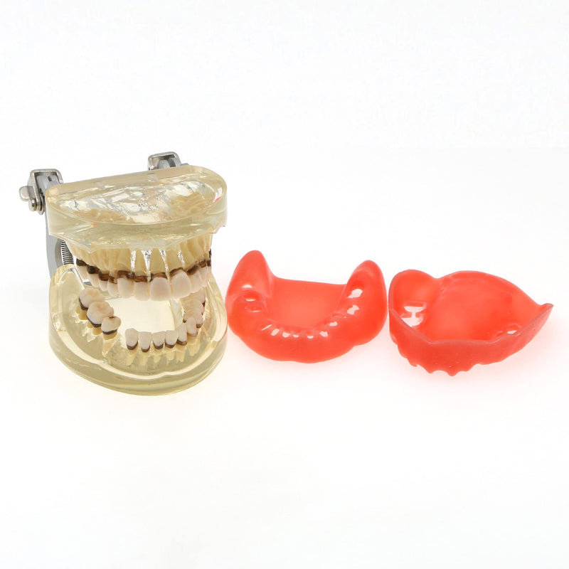[Australia - AusPower] - Dental Teeth Typodonts Model for Parodontopathy Periodontal Disease, Removable Gingivae Pathology Teeth Model Used in Teaching,Explain,Studying for Adult(Transparent) 