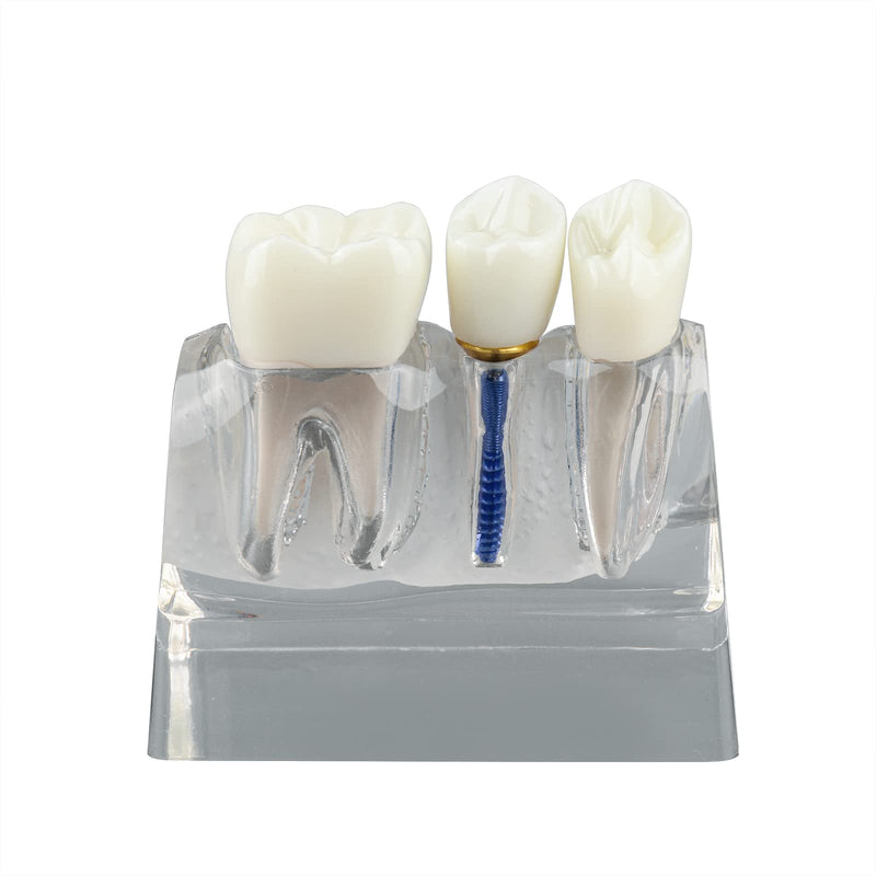 [Australia - AusPower] - Dental Implant Model for Patient Education, 4 Times Dental Implant, Crown and Bridge Model for Presentation-Transparent 