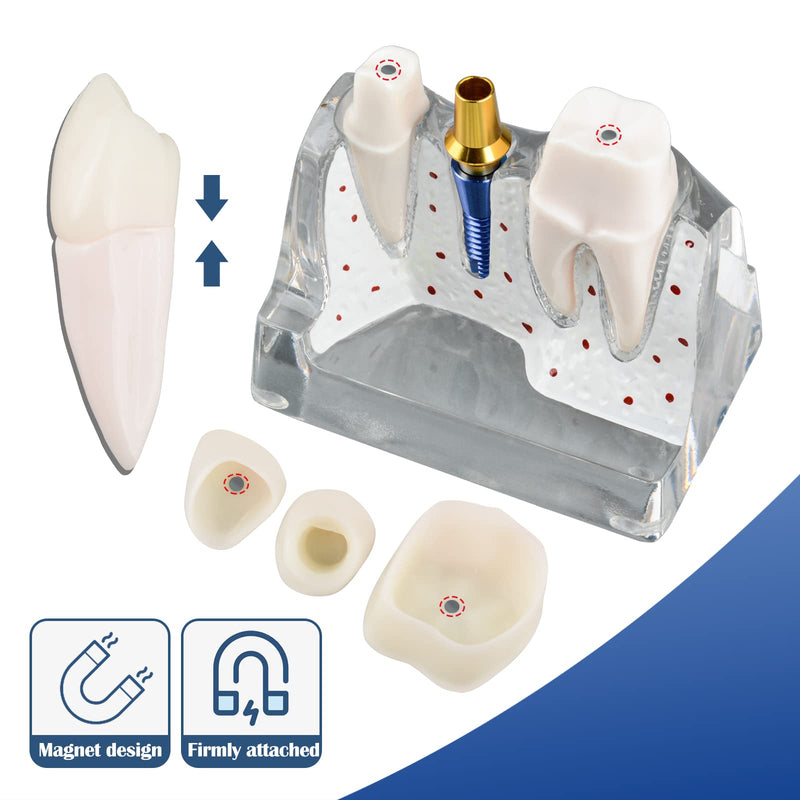 [Australia - AusPower] - Dental Implant Model for Patient Education, 4 Times Dental Implant, Crown and Bridge Model for Presentation-Transparent 