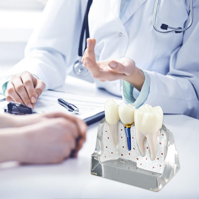 [Australia - AusPower] - Dental Implant Model for Patient Education, 4 Times Dental Implant, Crown and Bridge Model for Presentation-Transparent 