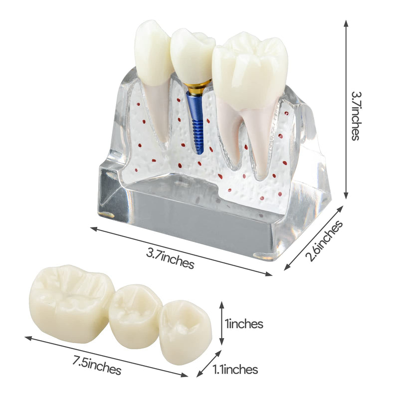 [Australia - AusPower] - Dental Implant Model for Patient Education, 4 Times Dental Implant, Crown and Bridge Model for Presentation-Transparent 