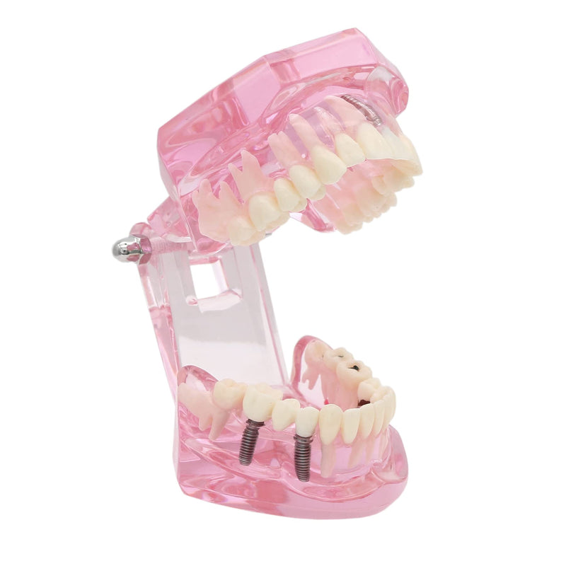 [Australia - AusPower] - Teeth Model Teeth Typodonts Dental Implant Study Analysis Demonstration Teeth Model #2001 with Restoration Pink 