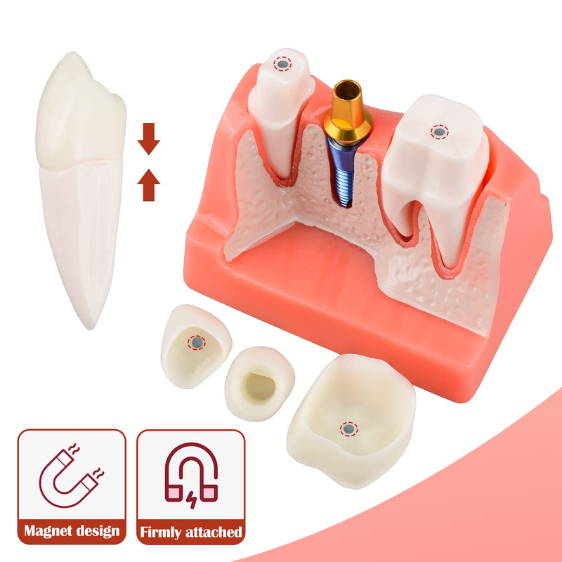 [Australia - AusPower] - Dental Implant Model for Patient Education, 4 Times Dental Implant, Crown and Bridge Model for Presentation-Pink 