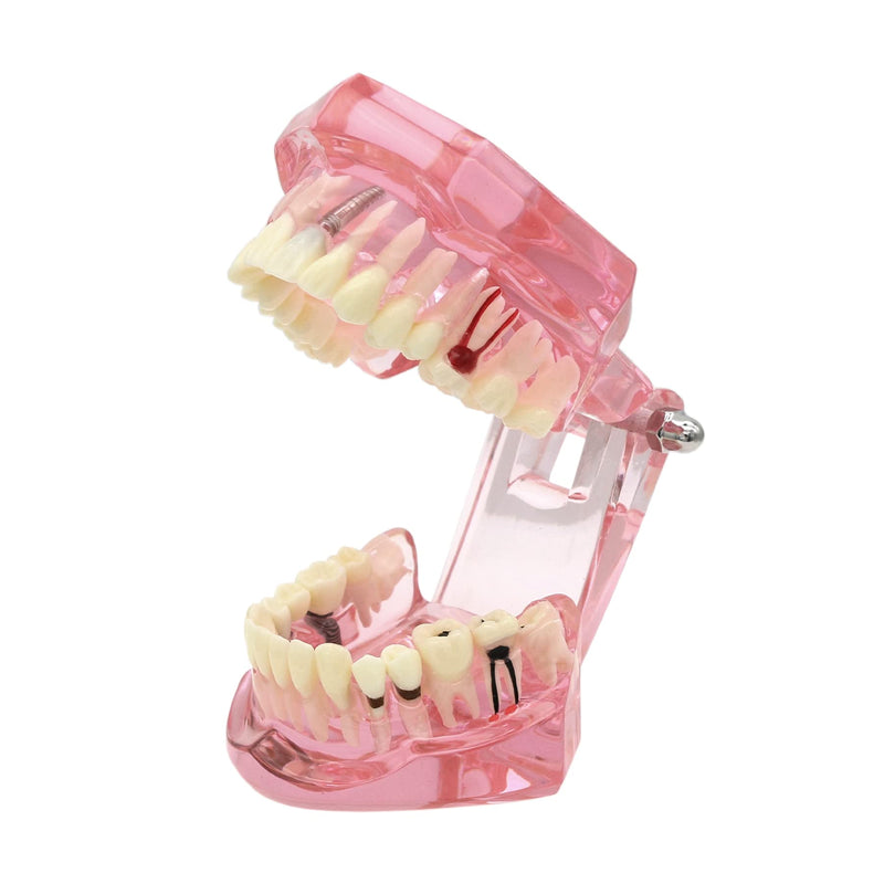 [Australia - AusPower] - Teeth Model Teeth Typodonts Dental Implant Study Analysis Demonstration Teeth Model #2001 with Restoration Pink 